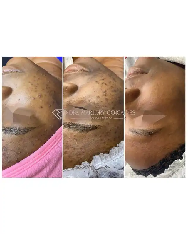 Resultado acne e harmonização facial