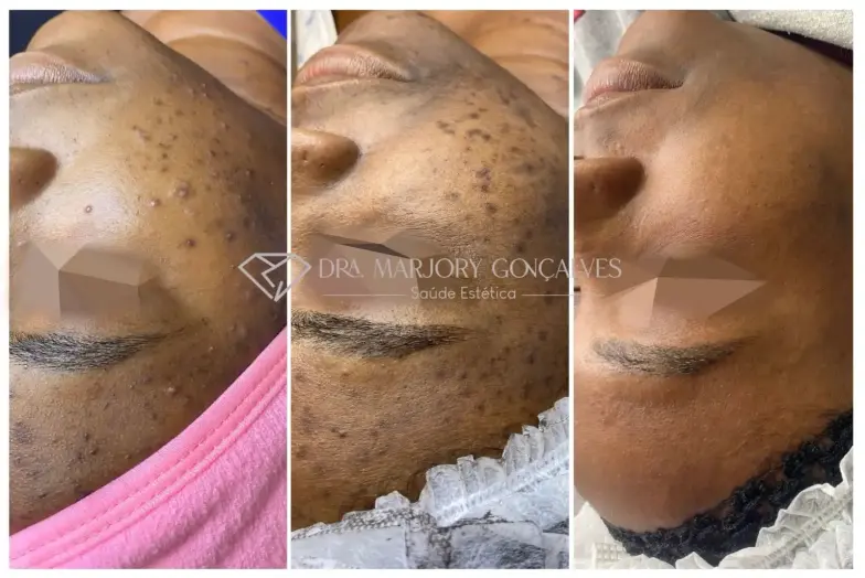 Resultado acne com homecare personalizado