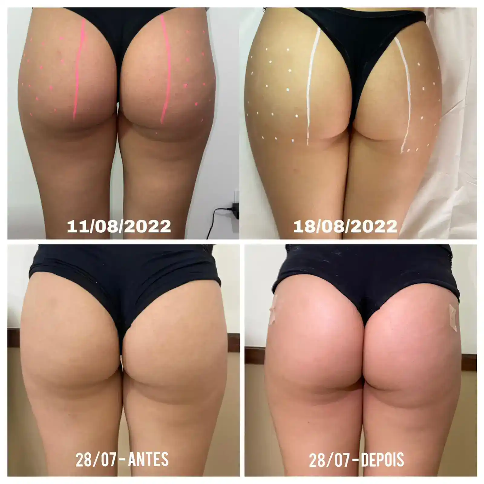 Resultado bioestimulador harmonização de glúteo