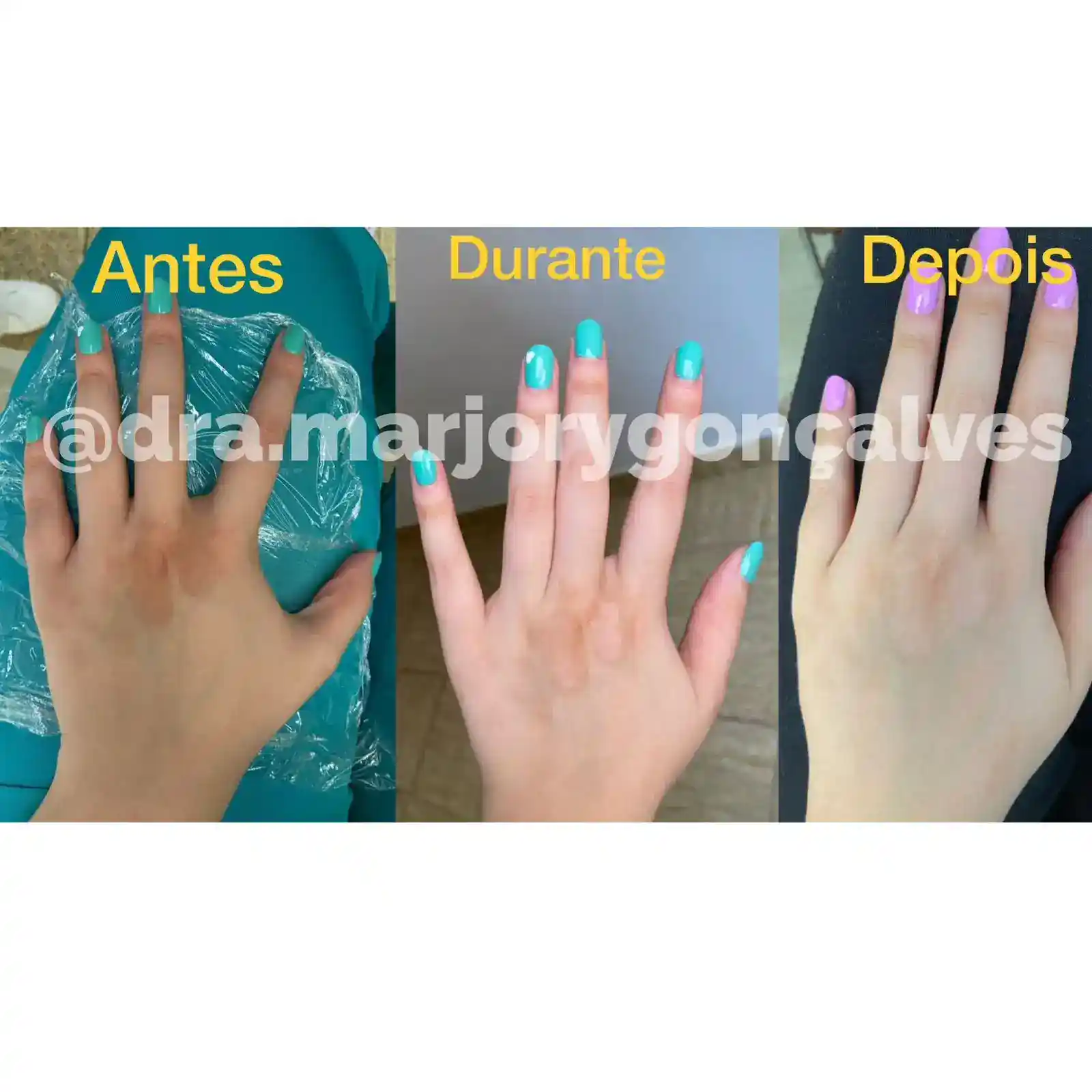 Resultado cicatrizes nas mãos antes e depois