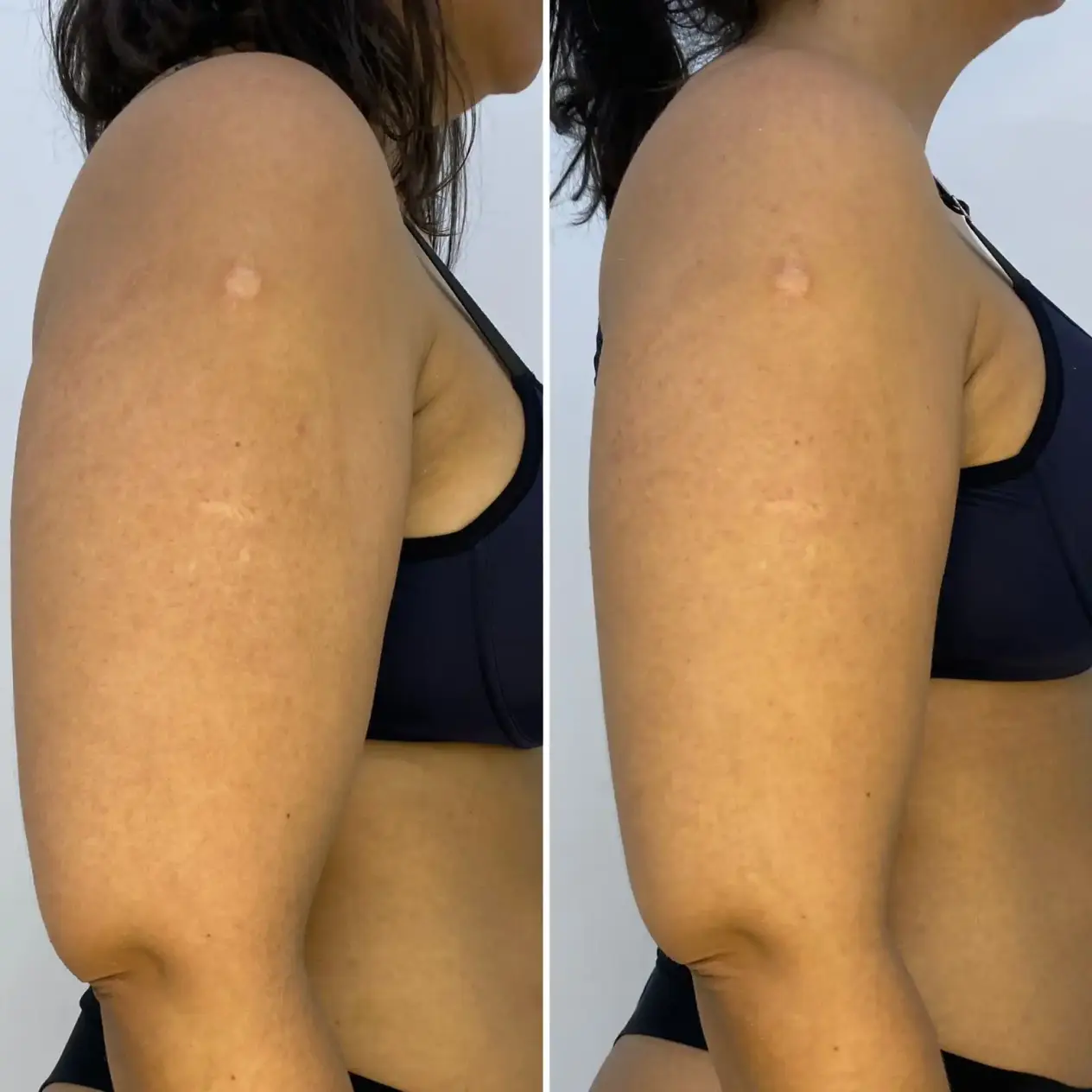 Resultado endolaser braços emagrecimento e modelagem