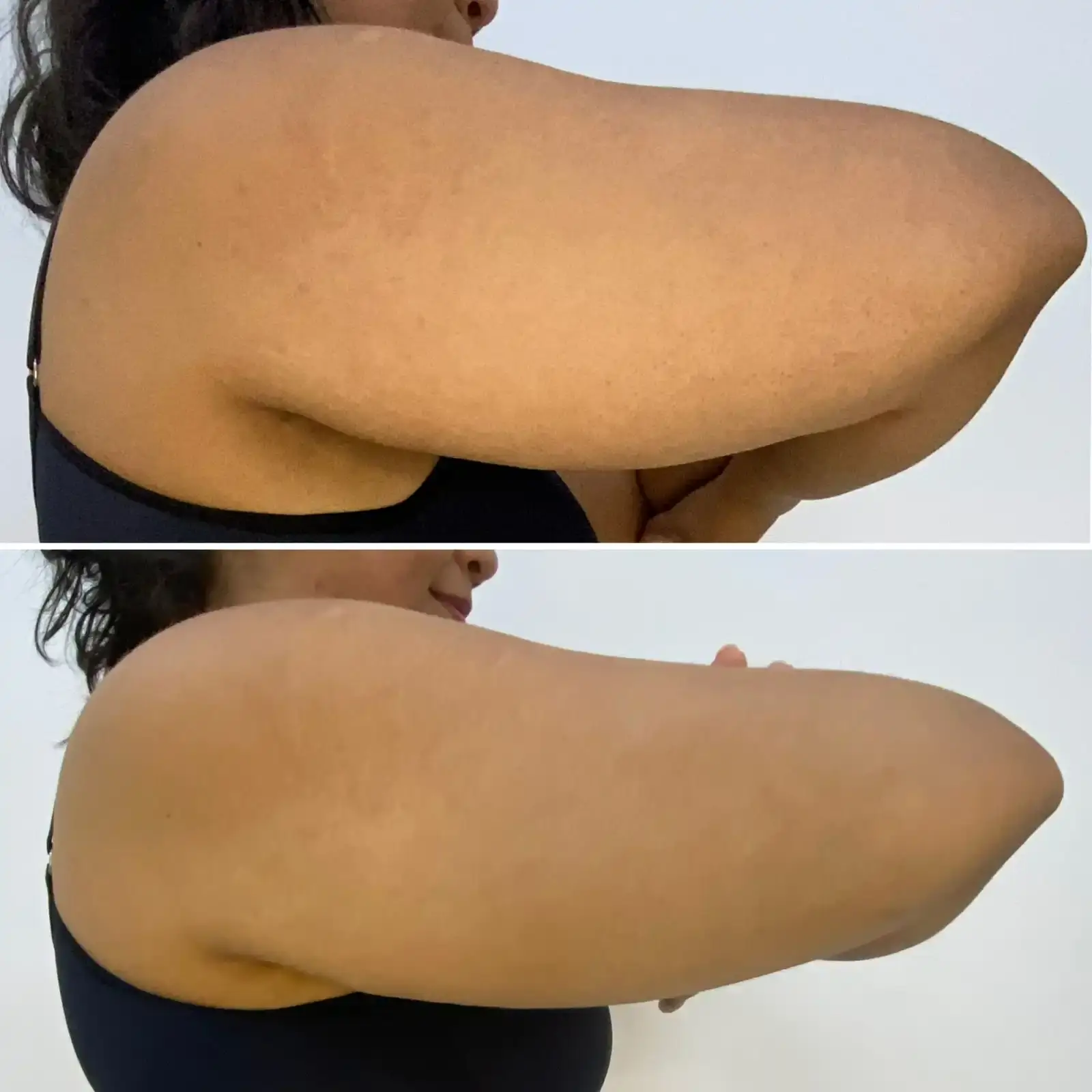 Resultado endolaser braços modelagem
