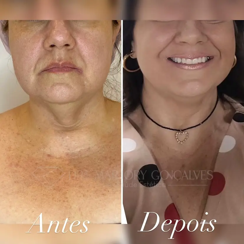 Resultado endolaser pescoço e facial