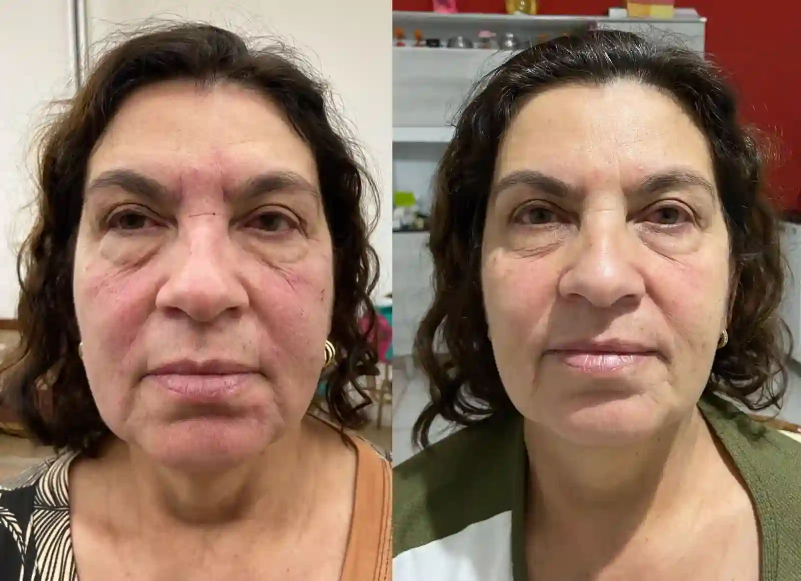Resultado ozônio harmonização e rejuvenescimento