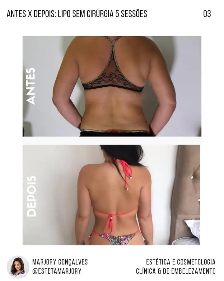 Resultado lipo sem cirurgia costas