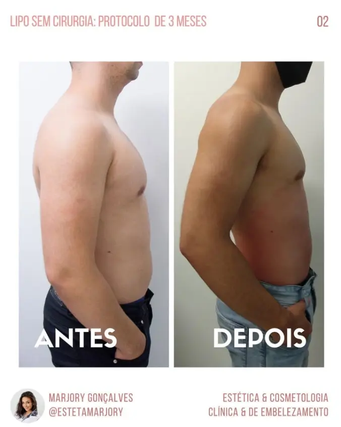 Resultado lipo sem cirurgia