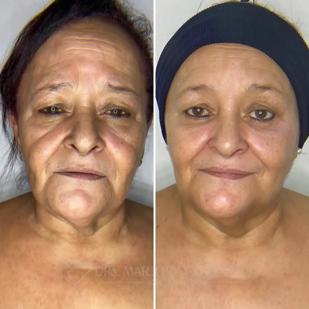Resultado rejuvenescimento facial