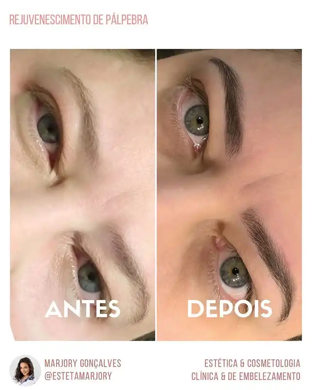 Resultado rejuvenescimento de pálpebra