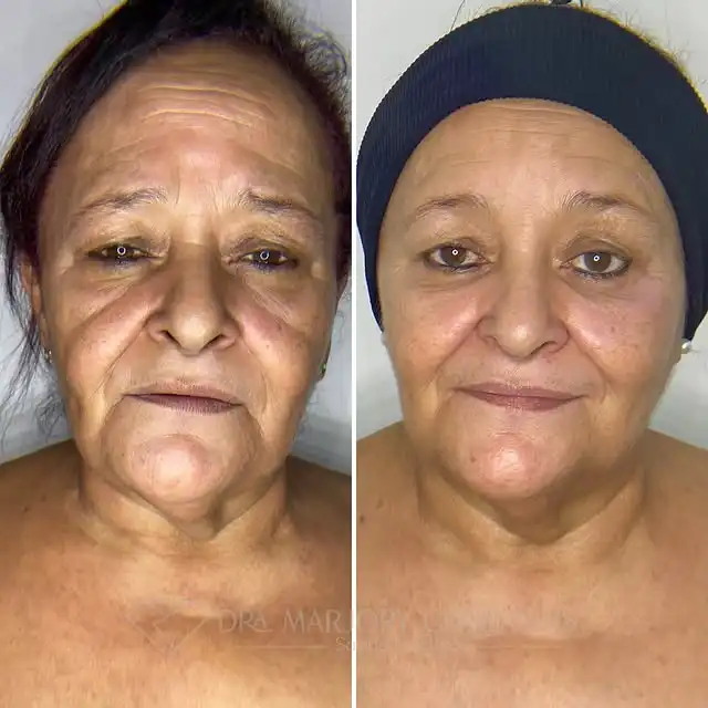 Resultado rejuvenescimento facial fullface endolaser