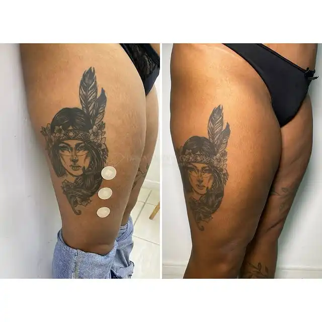 Resultado celulite e definição de perna